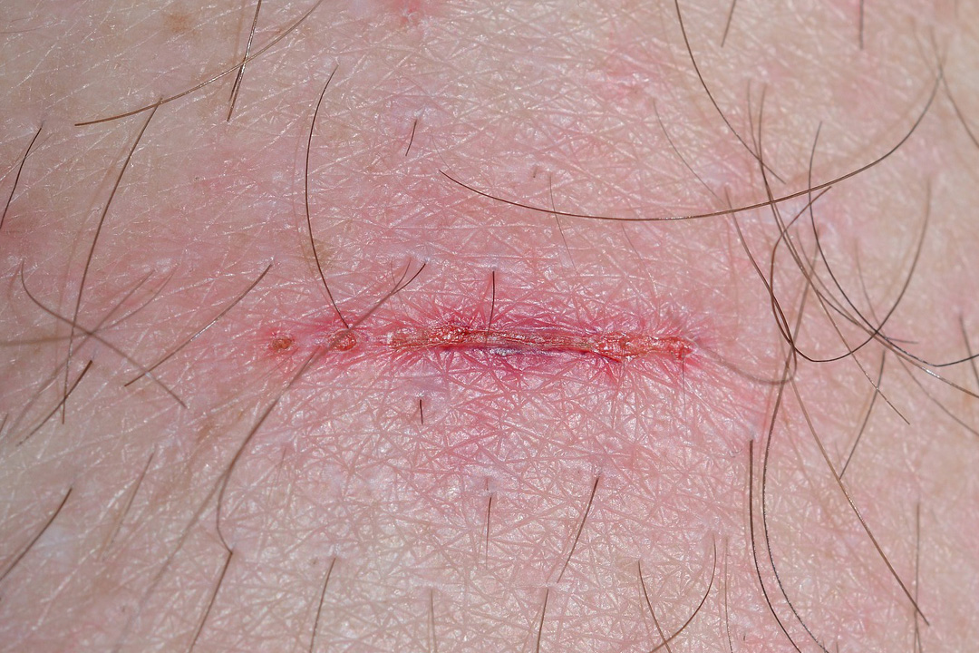Berries-Health-Genetic-wound Berries Health Genetic wound
